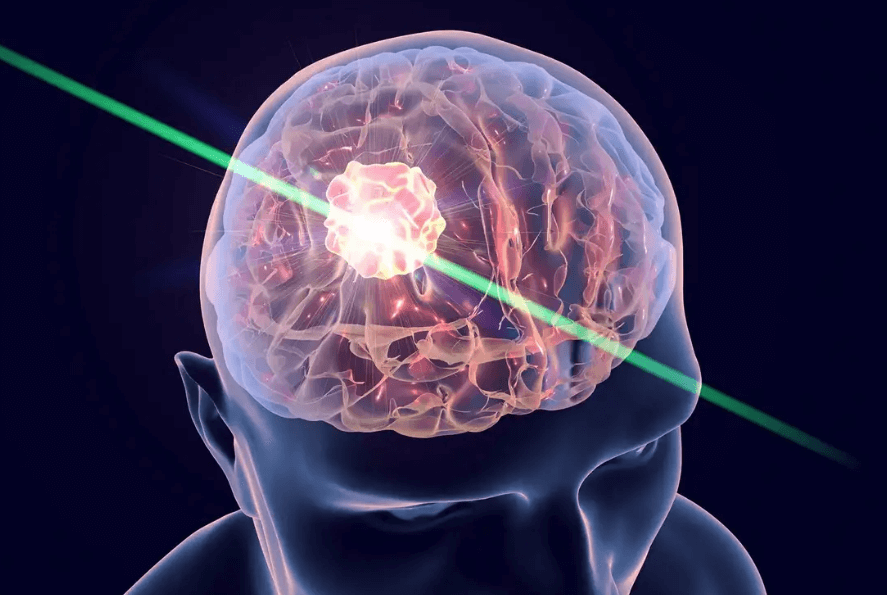 Scientists Kill Brain Cancer with Quantum Therapy Spray 