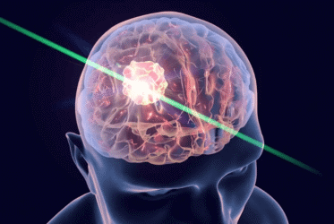 Scientists Kill Brain Cancer with Quantum Therapy Spray 2 Scientists Kill Brain Cancer with Quantum Therapy Spray