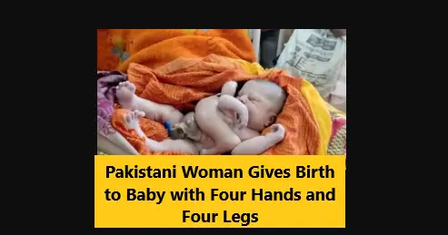 You are currently viewing Pakistani Woman Gives Birth to Baby with Four Hands and Four Legs